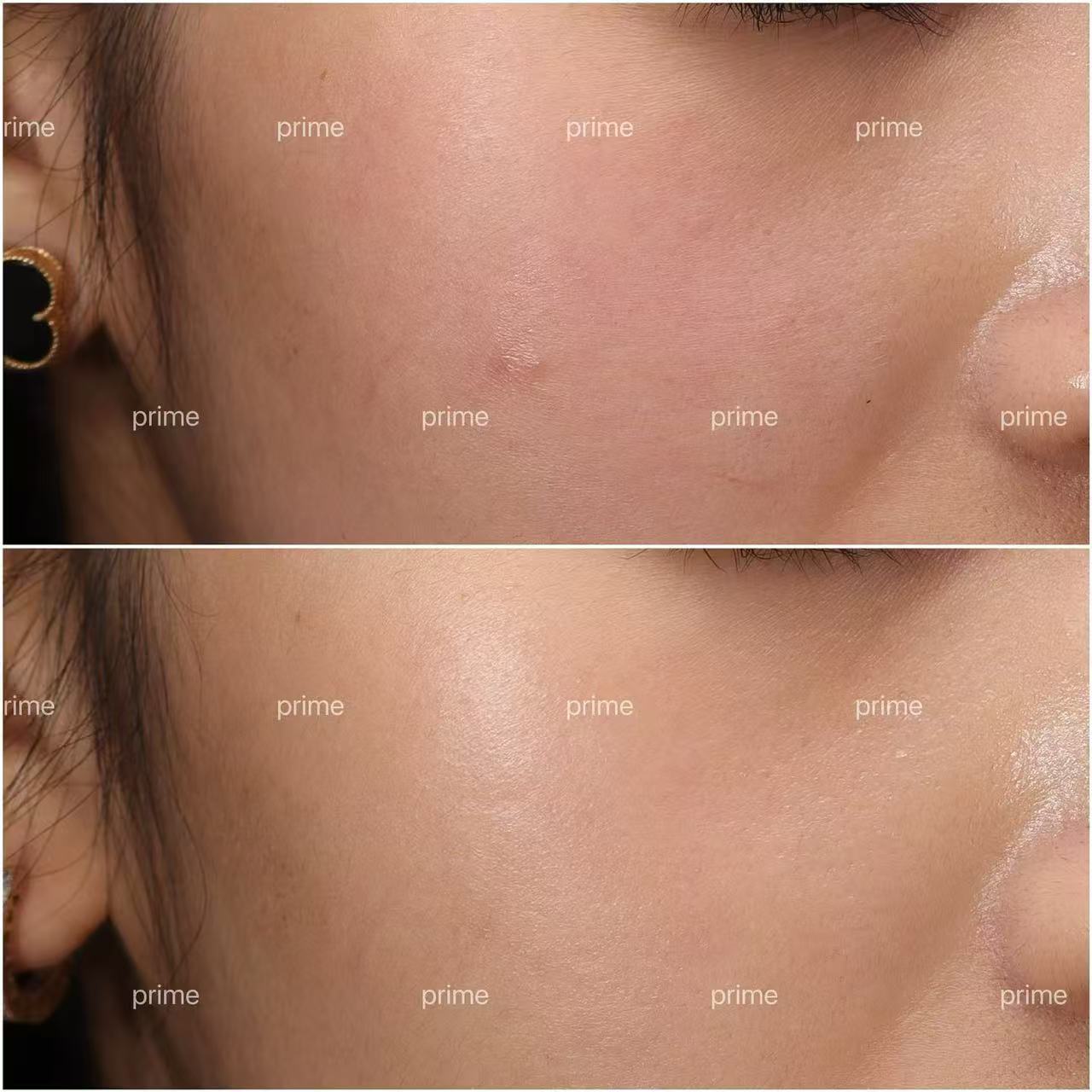 Alma Harmony before and after skin clarity result from Prime Cosmetic Clinic