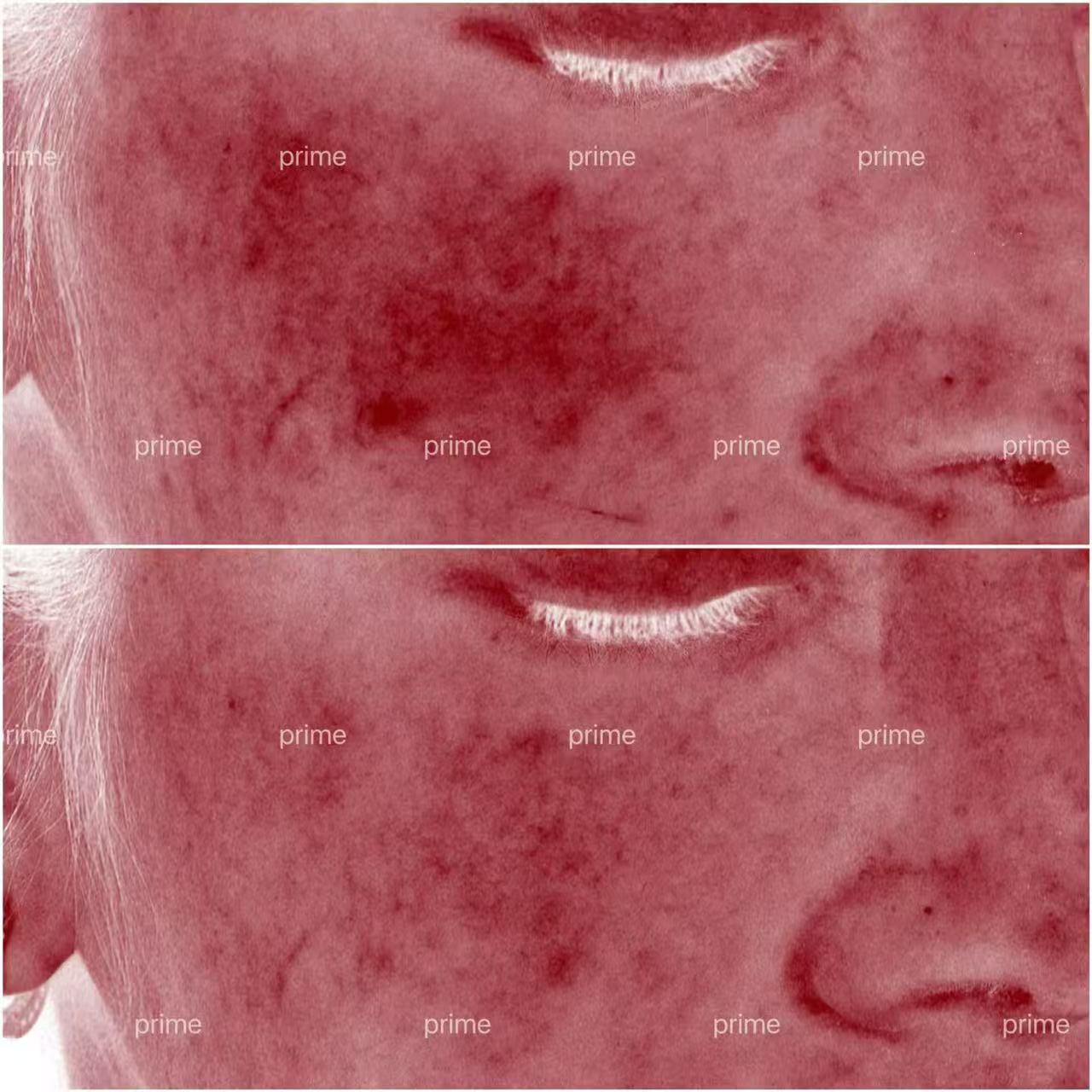 Alma Harmony before and after redness result from Prime Cosmetic Clinic