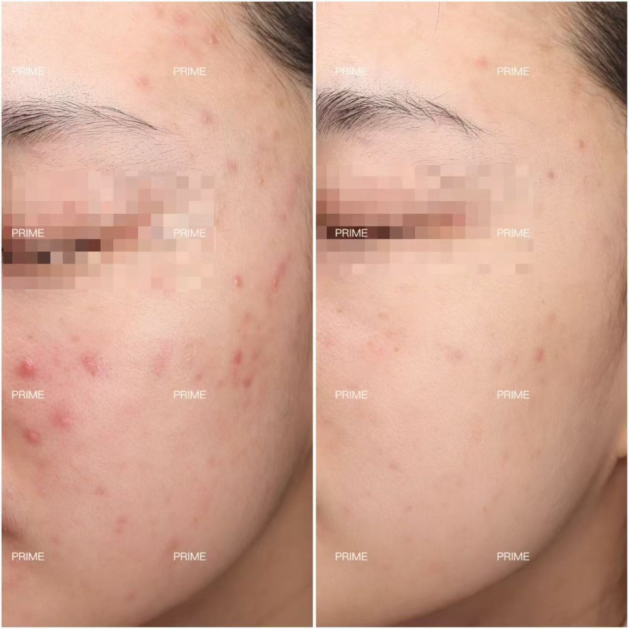 Alma Harmony before and after acne result from Prime Cosmetic Clinic