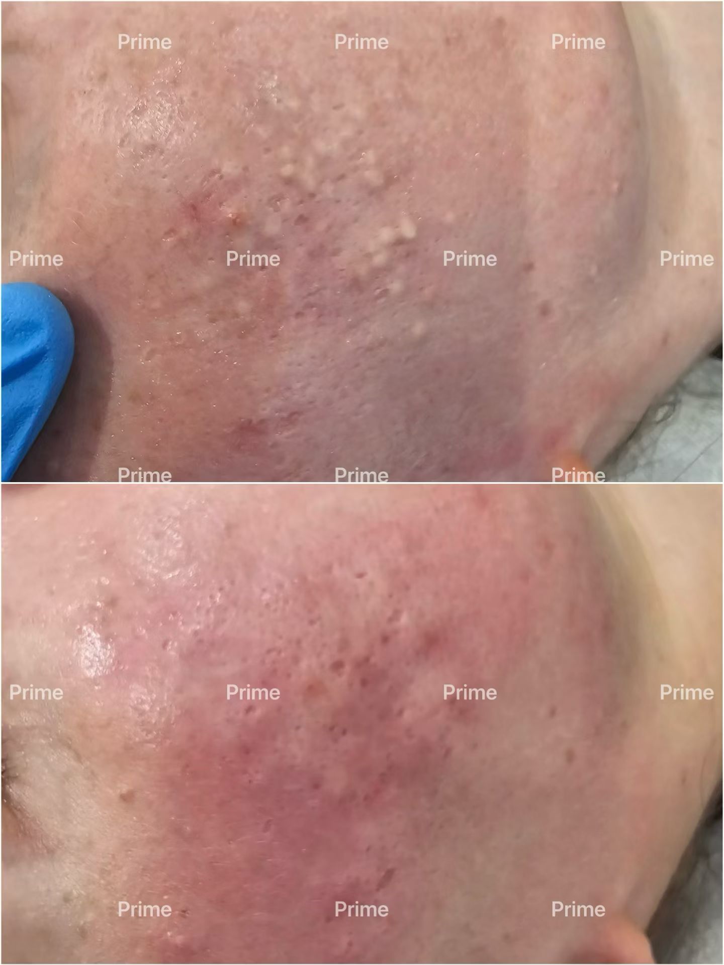 Extraction Facial congestion and closed comedones before and after result from Prime Cosmetic Clinic