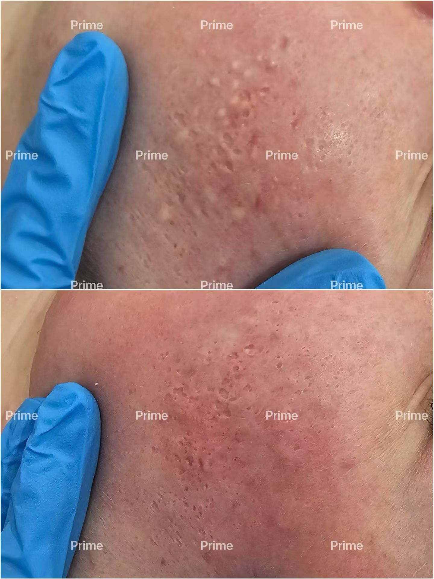 Extraction Facial deep pore cleansing and texture improvement before and after result from Prime Cosmetic Clinic