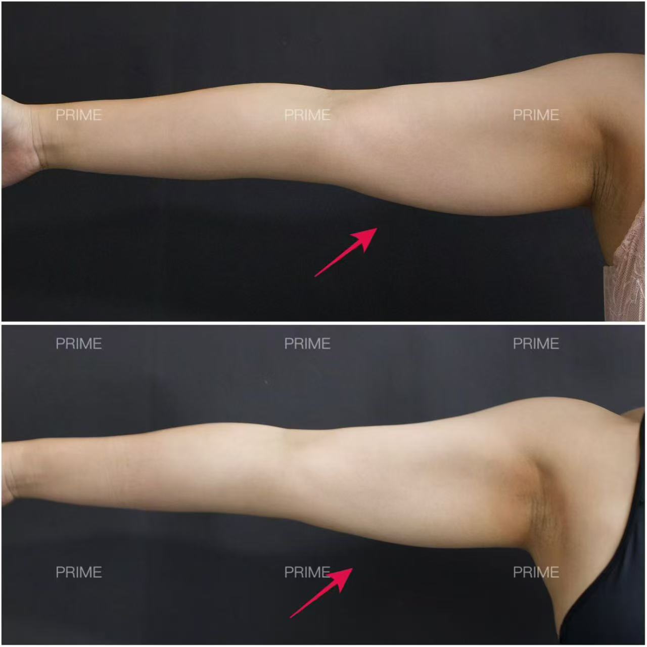 Lipocel before and after arm fat reduction result from Prime Cosmetic Clinic