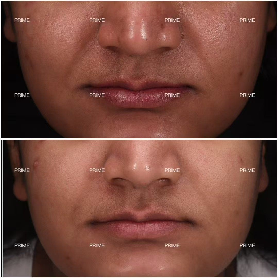 Morpheus8 before and after result from Prime Cosmetic Clinic