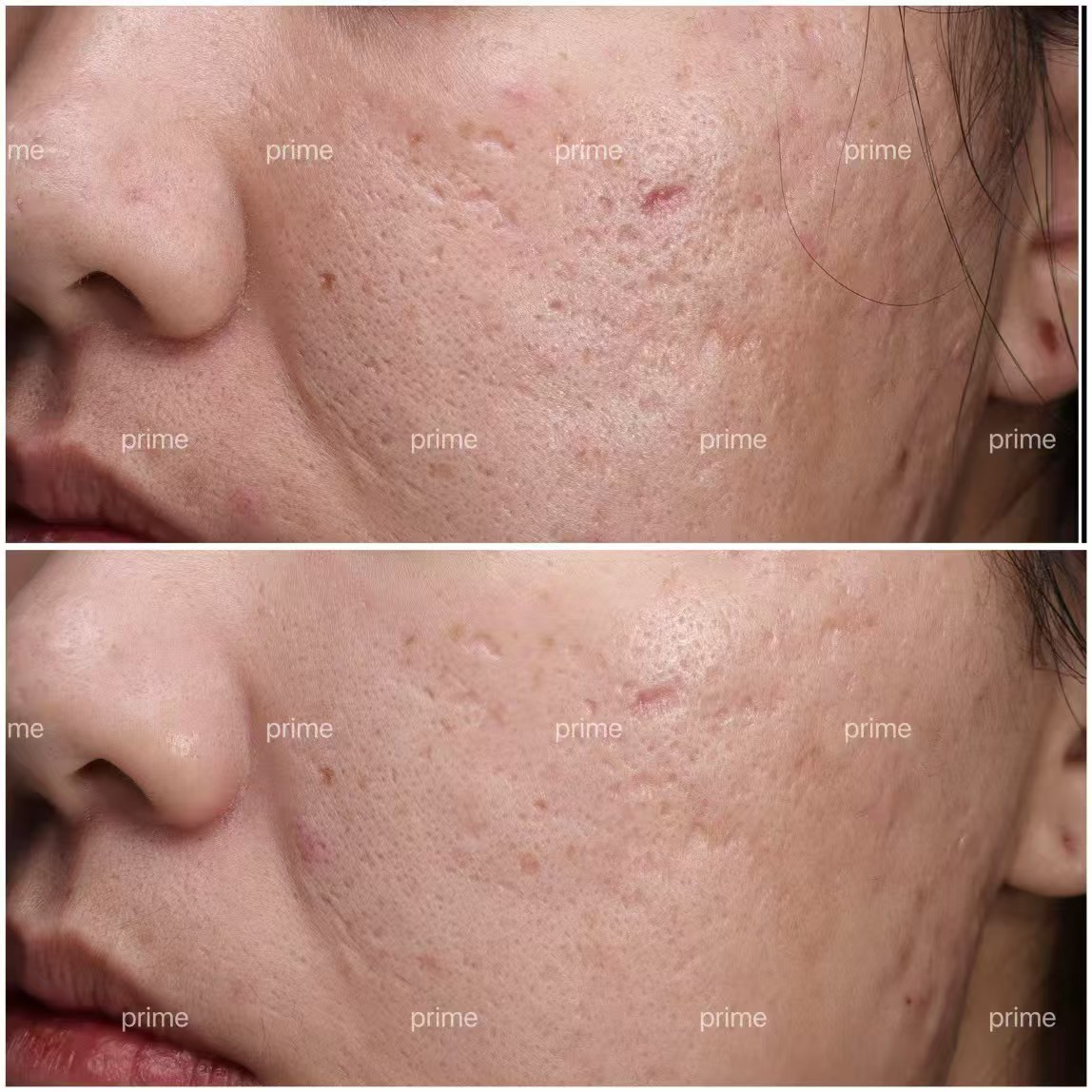 Morpheus8 acne scarring before and after result from Prime Cosmetic Clinic