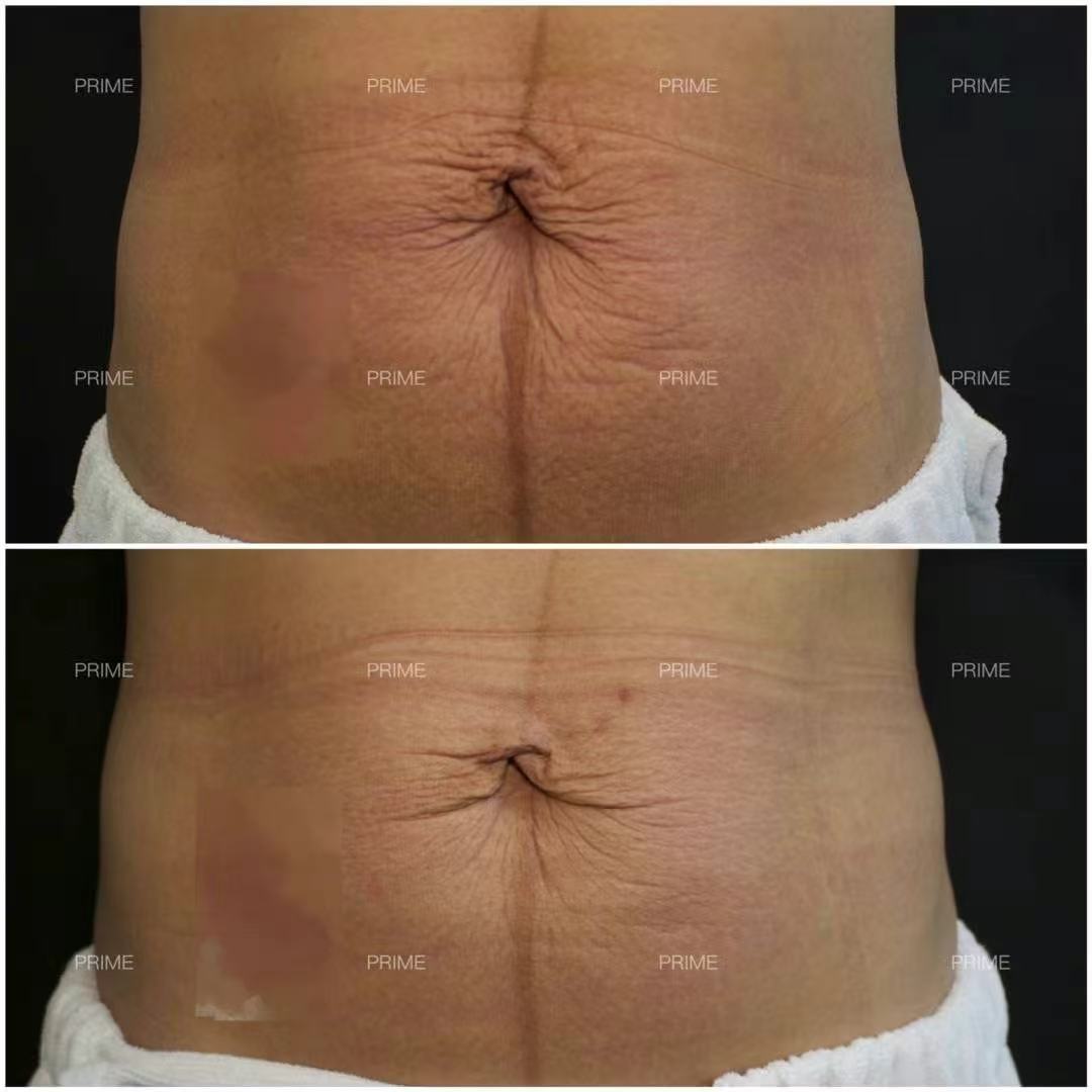 Abdominal stretch mark before and after
