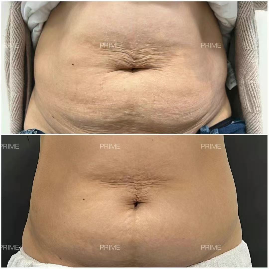 Combined LipoCel and Morpheus8 Body abdomen before and after result from Prime Cosmetic Clinic
