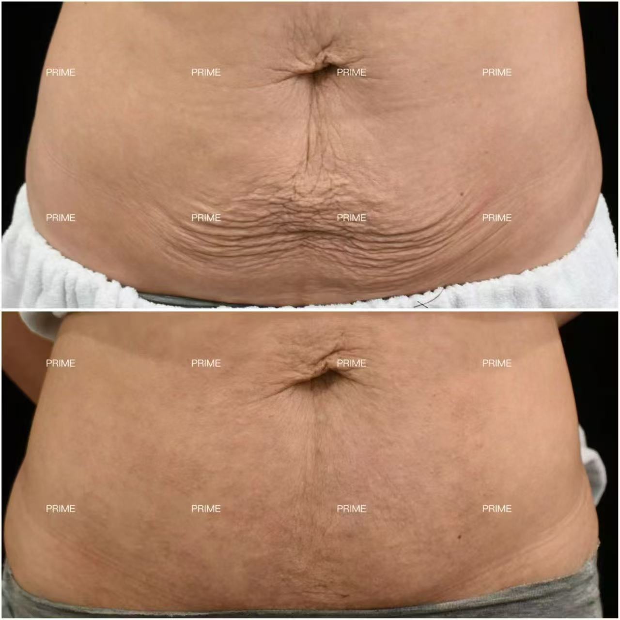 Morpheus8 Body abdomen skin tightening before and after result from Prime Cosmetic Clinic