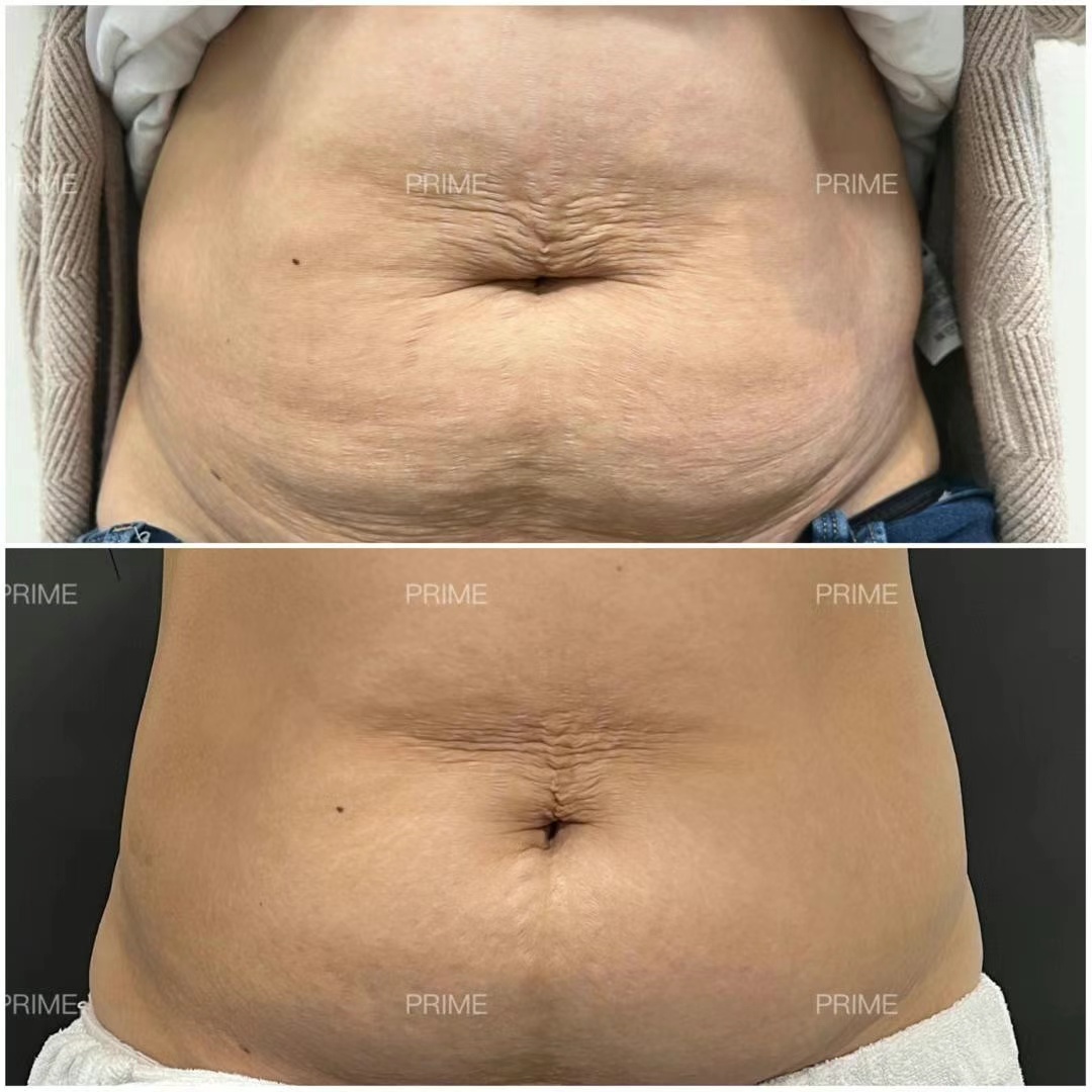Morpheus8 Body postnatal abdominal skin before and after result from Prime Cosmetic Clinic