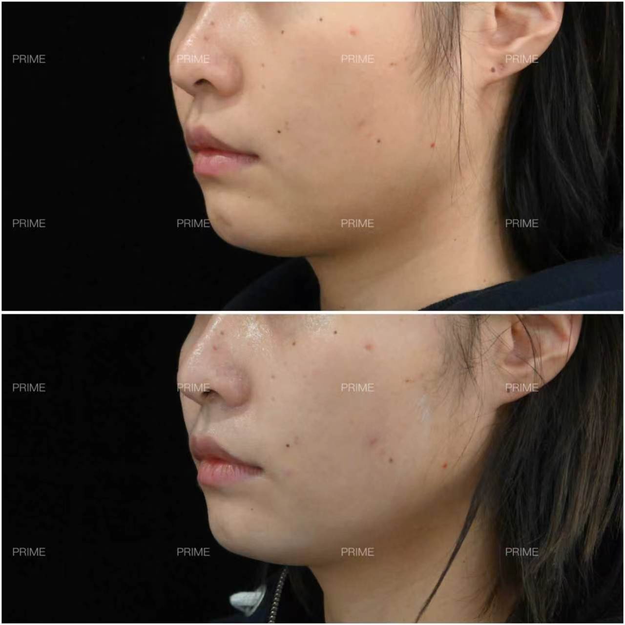 Thermage FLX before and after facial tightening result from Prime Cosmetic Clinic