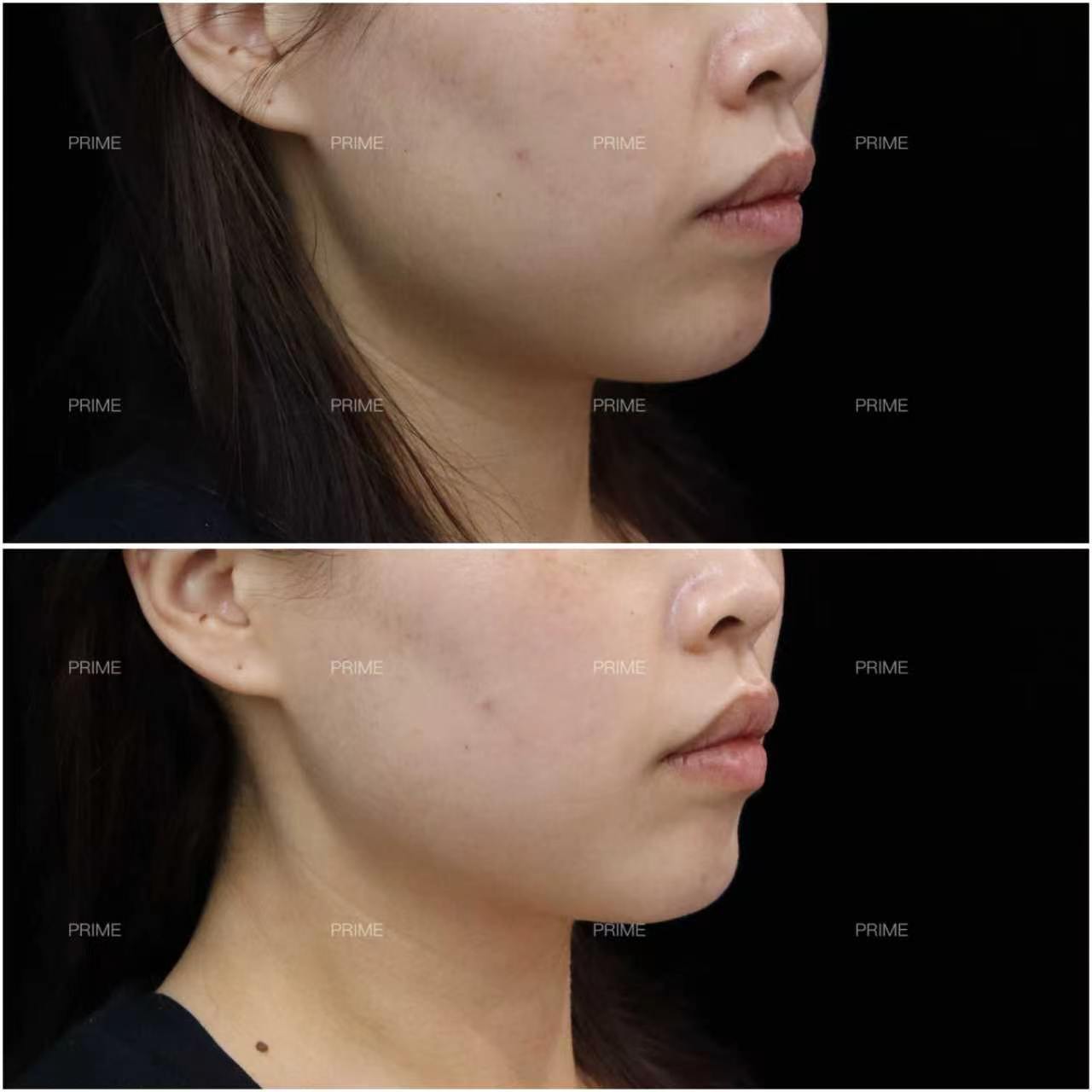 Thermage FLX before and after side profile lifting result from Prime Cosmetic Clinic