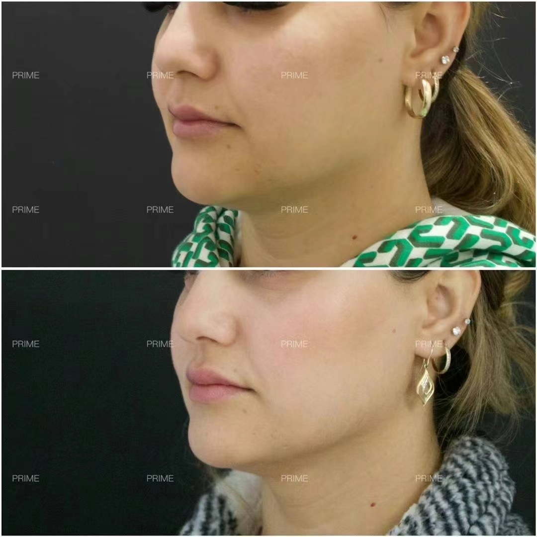 Thermage FLX before and after eye area tightening result from Prime Cosmetic Clinic