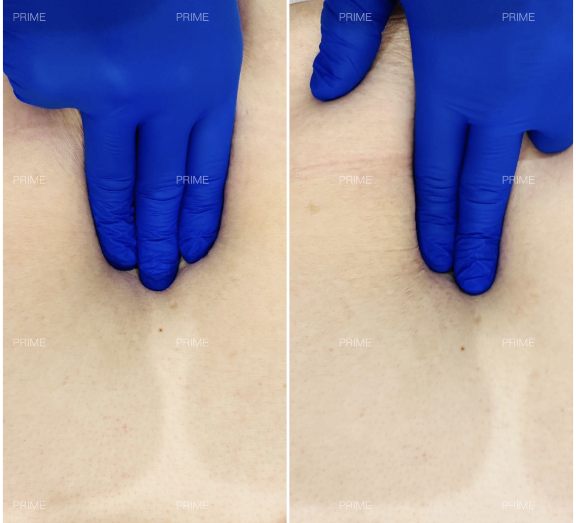 Tone before and after abdominal muscle tone result