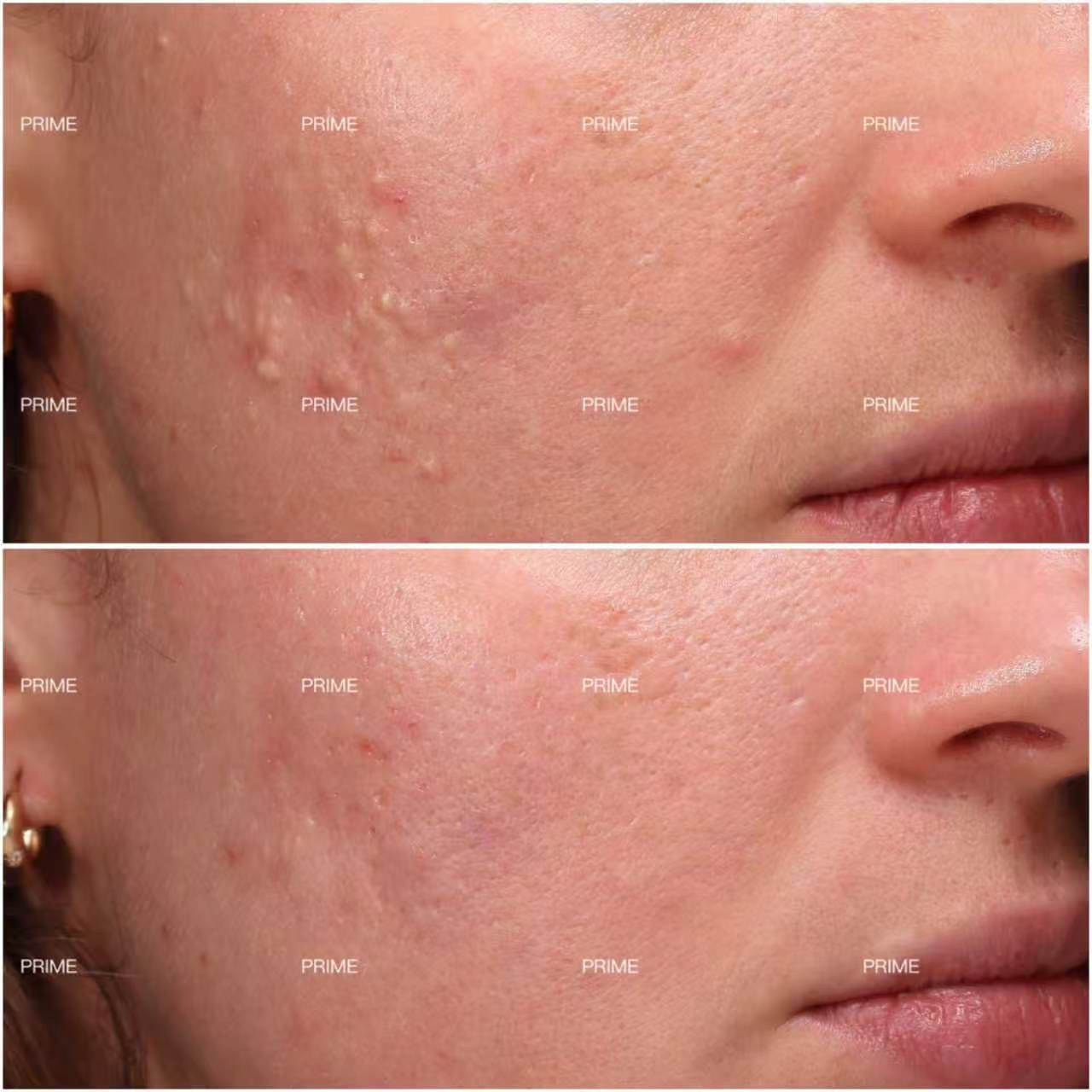 Extraction Facial congestion and closed comedones before and after result from Prime Cosmetic Clinic
