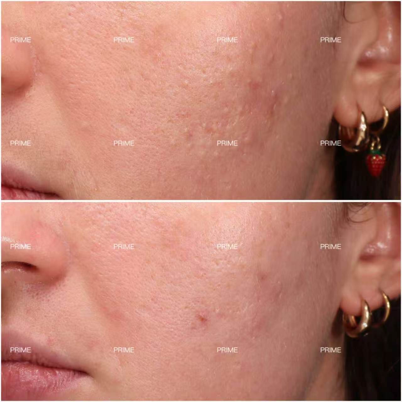 Extraction Facial deep pore cleansing and texture improvement before and after result from Prime Cosmetic Clinic
