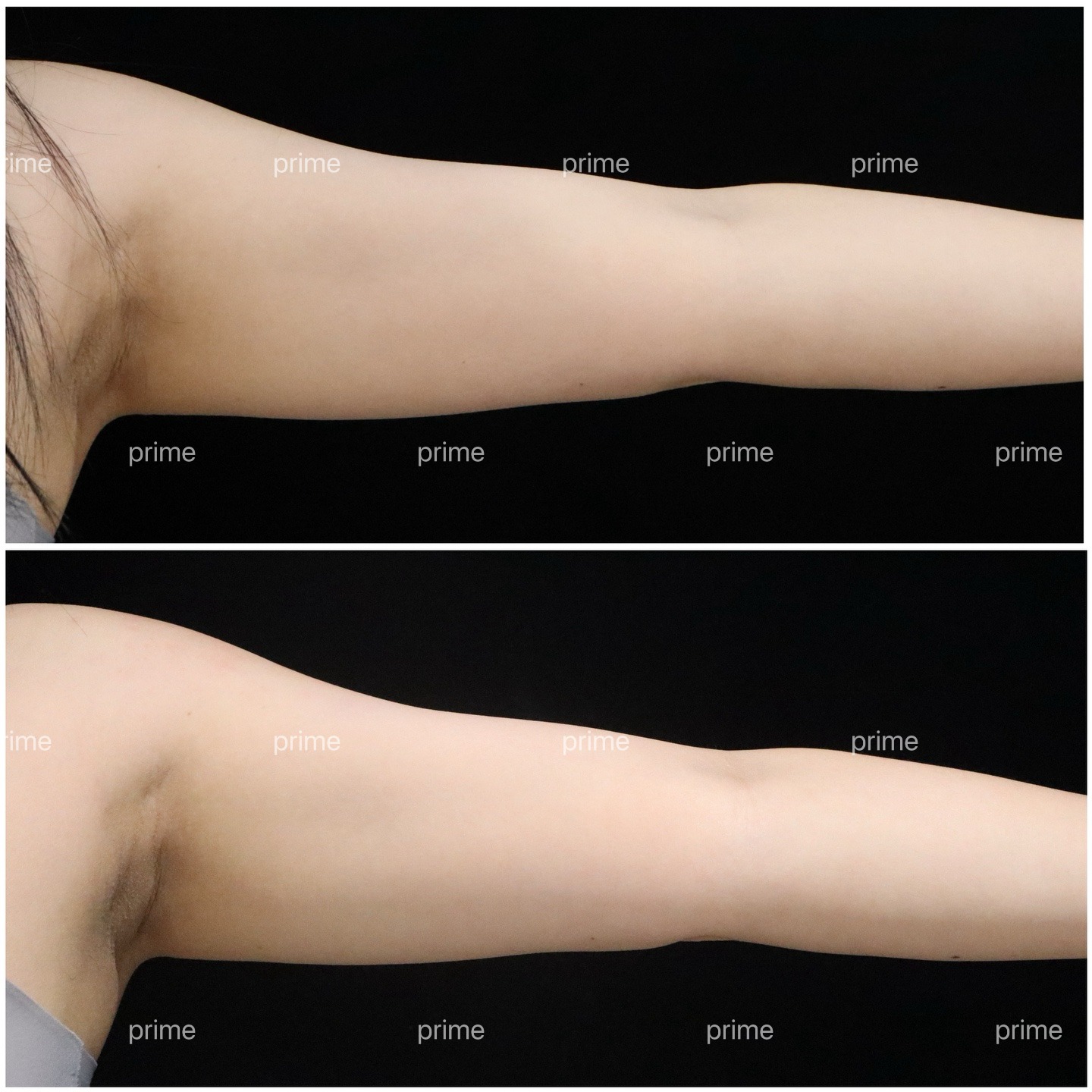 MiniFX before and after result 01 from Prime Cosmetic Clinic