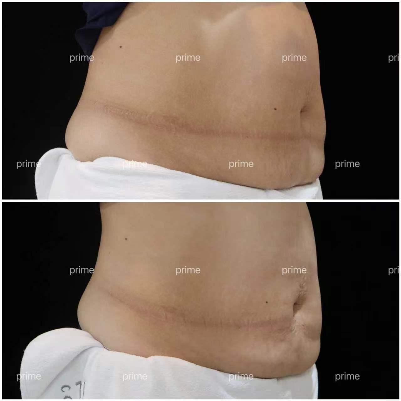 MiniFX before and after result 02 from Prime Cosmetic Clinic