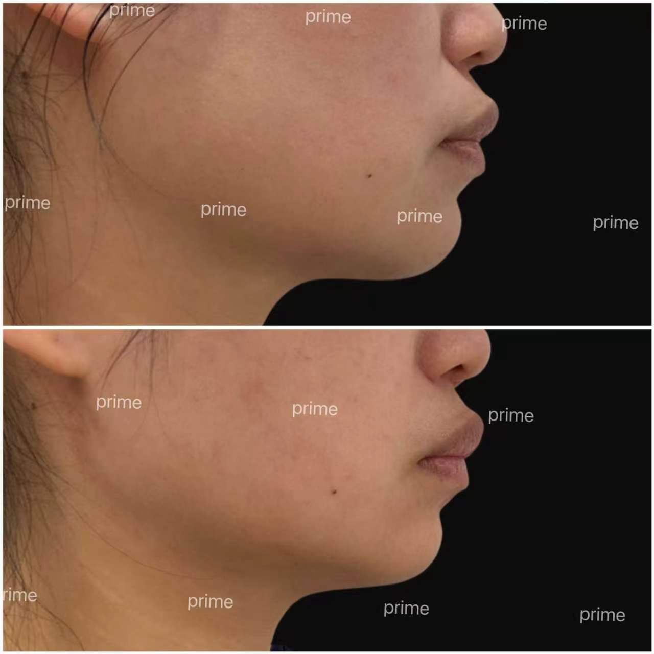 MiniFX before and after result 03 from Prime Cosmetic Clinic