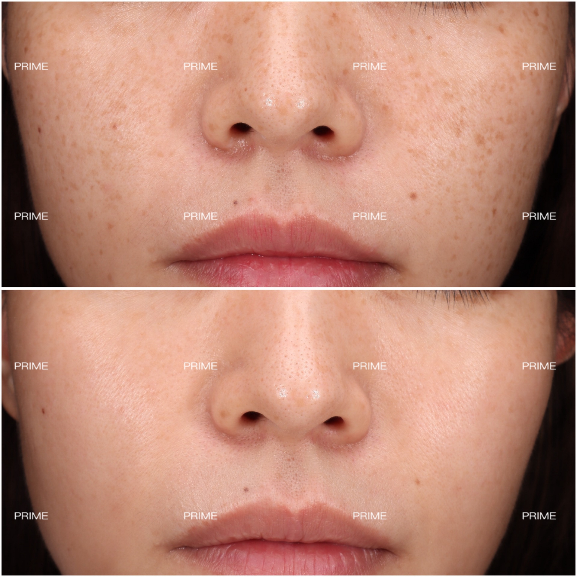 PicoSure Pro pigmentation before and after result from Prime Cosmetic Clinic