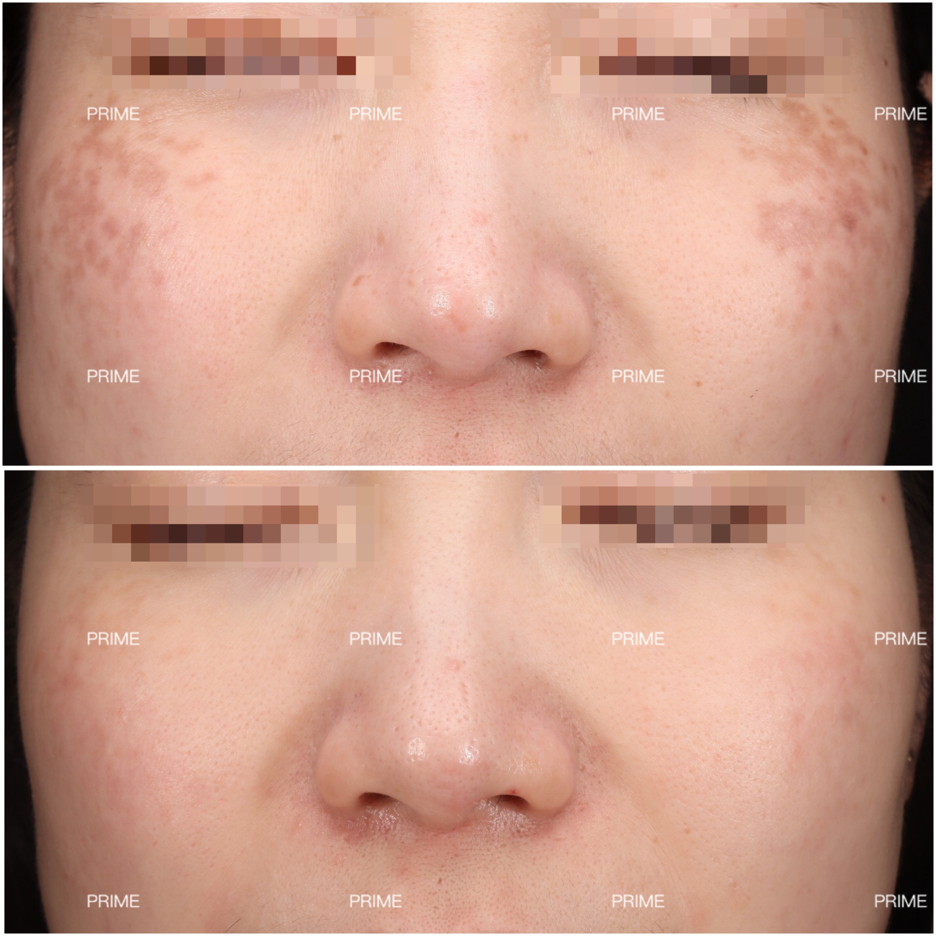 PicoSure Pro facial pigmentation before and after result from Prime Cosmetic Clinic