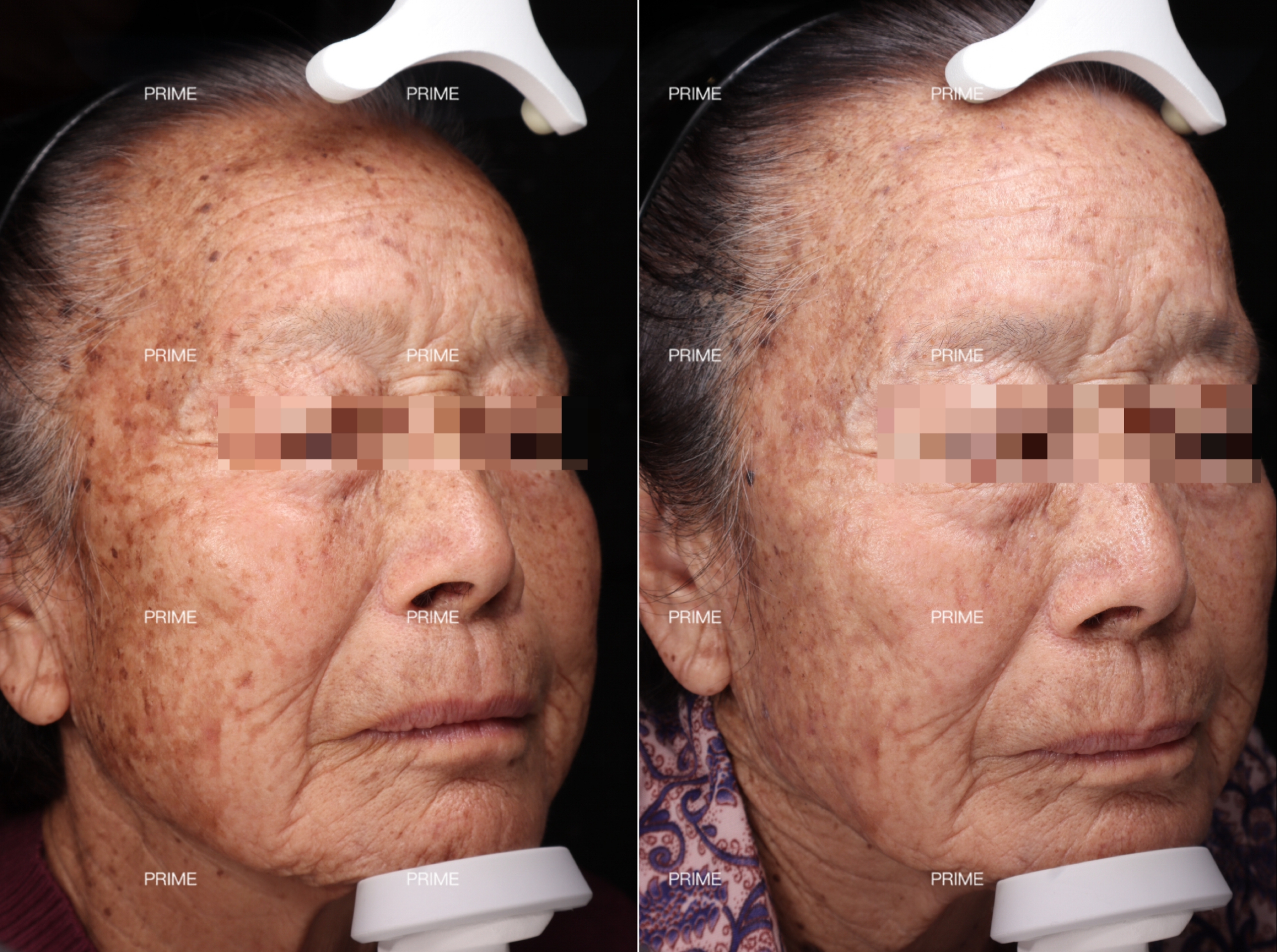 PicoSure Pro pigmentation treatment before and after result from Prime Cosmetic Clinic