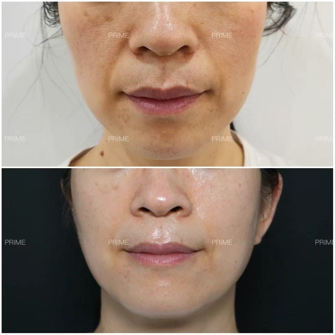 Thermage FLX lower face before and after result from Prime Cosmetic Clinic