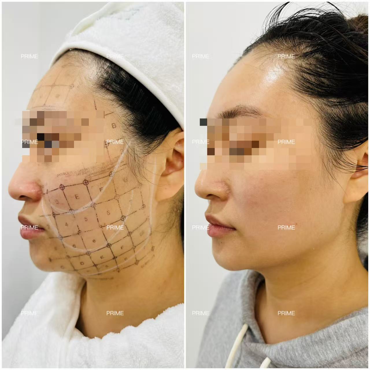 Thermage FLX before and after side profile lifting result from Prime Cosmetic Clinic