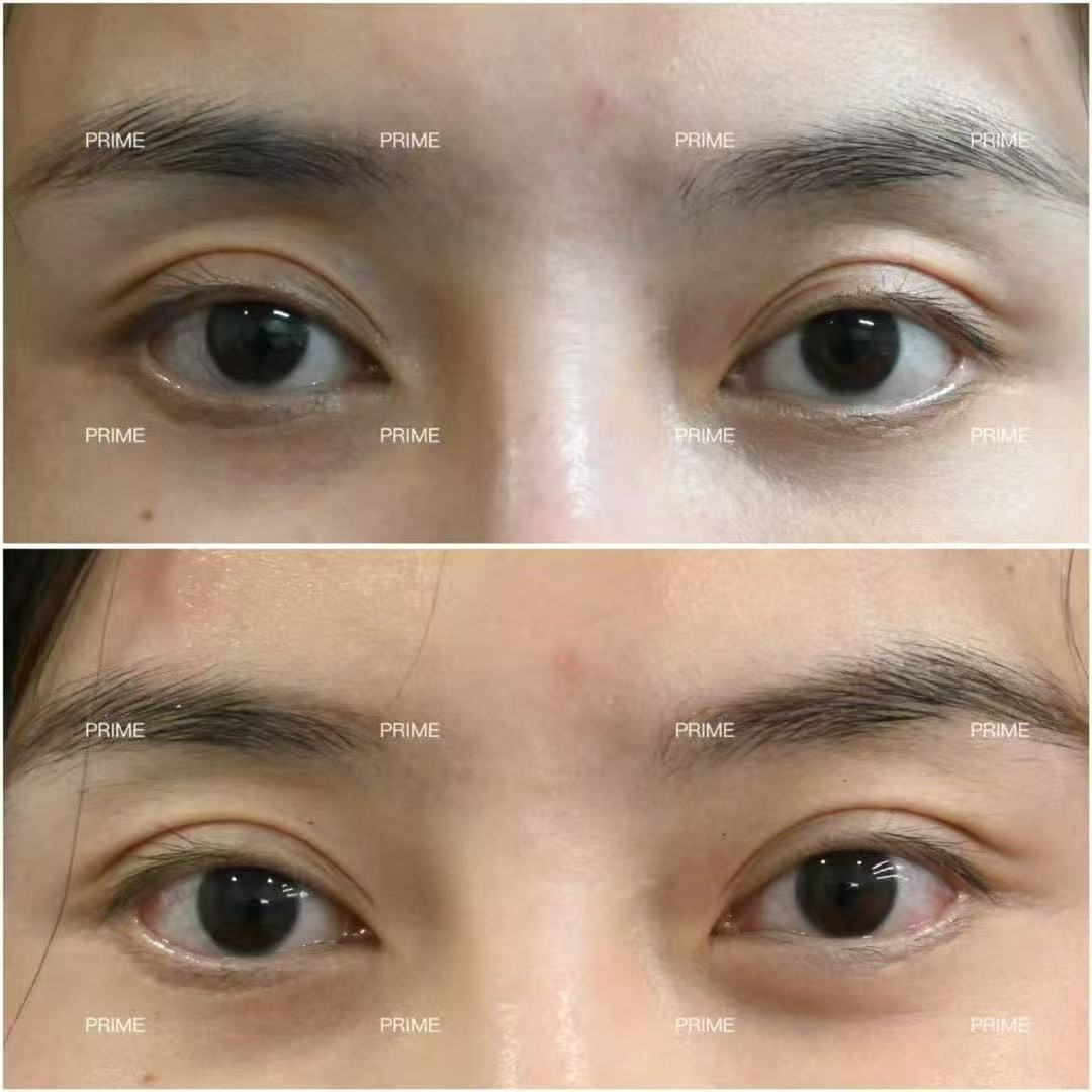 Thermage FLX before and after eye area tightening result from Prime Cosmetic Clinic