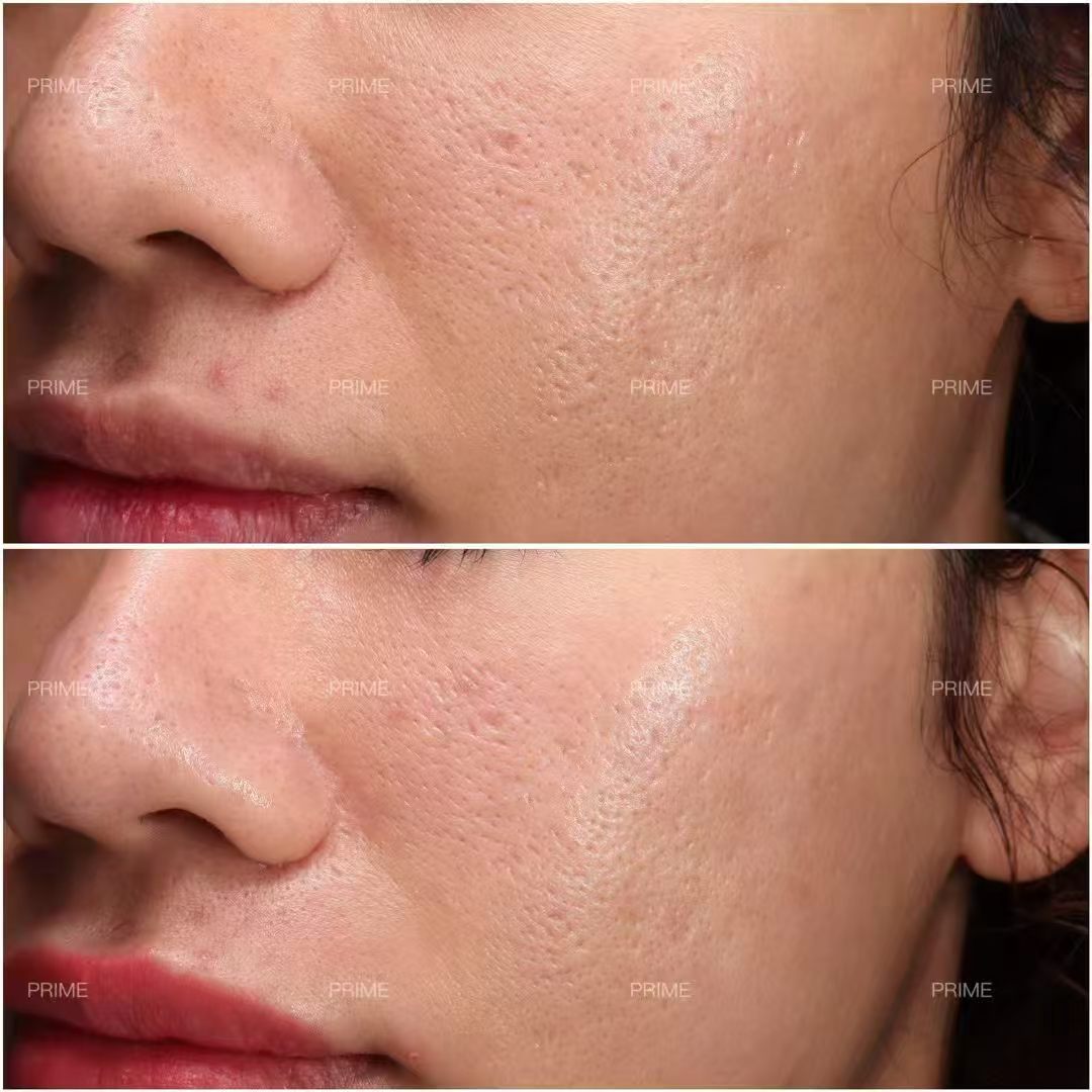 Venus Viva before and after result from Prime Cosmetic Clinic