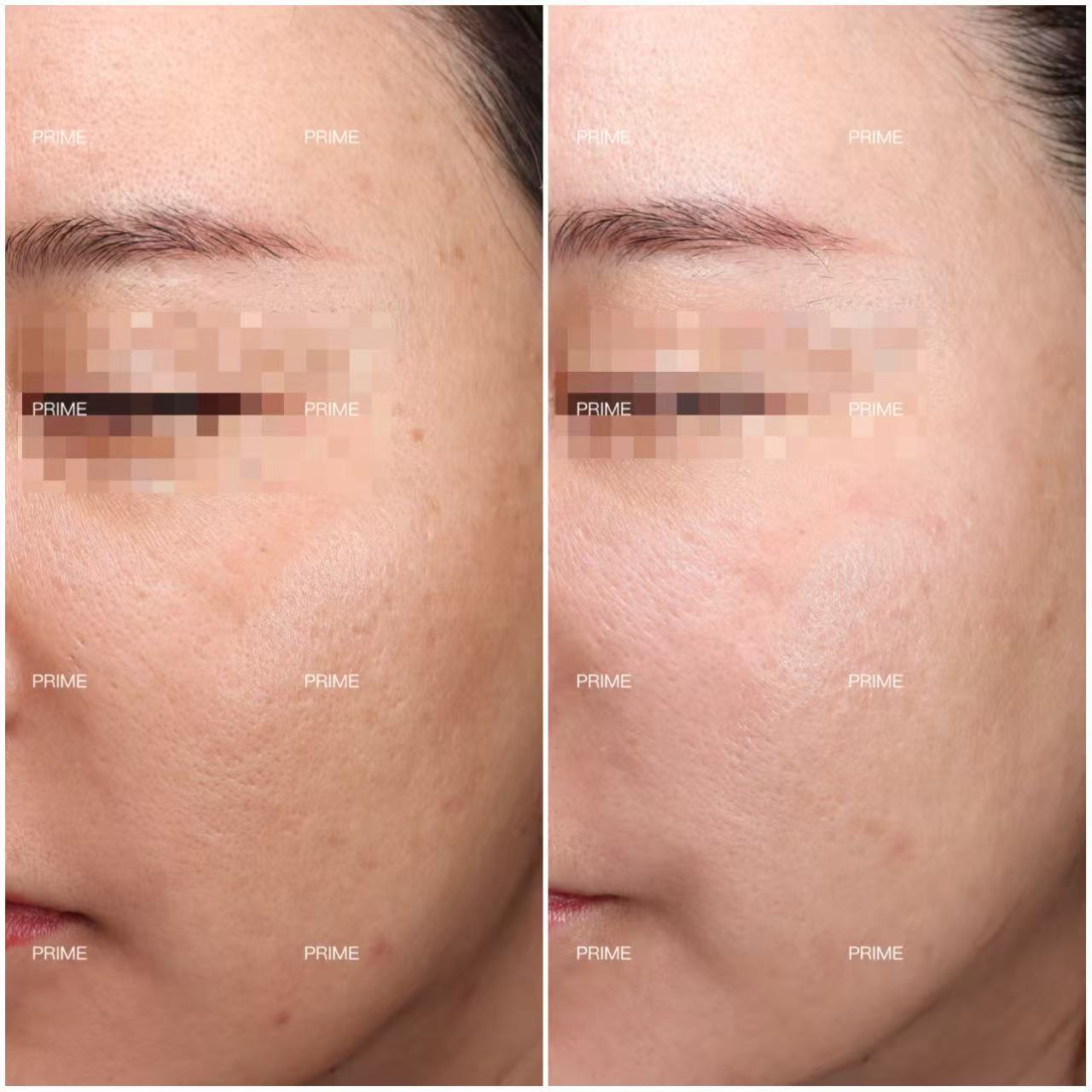 Venus Viva skin clarity before and after result from Prime Cosmetic Clinic