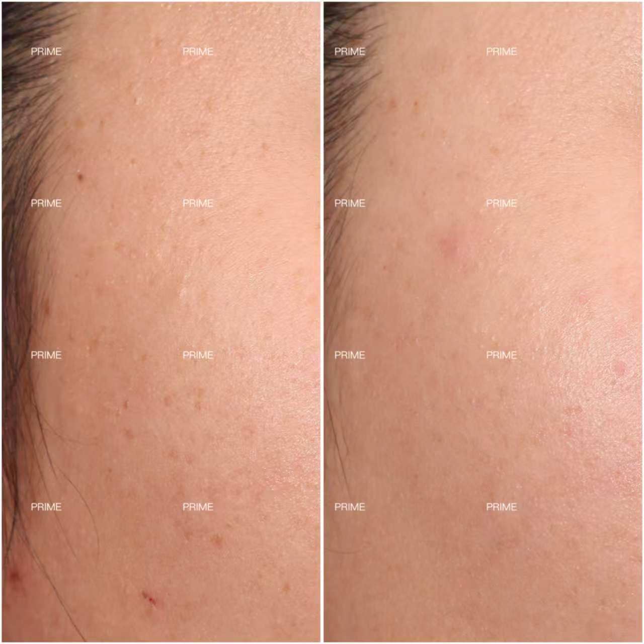 Skin lesion removal before and after result 01 from Prime Cosmetic Clinic