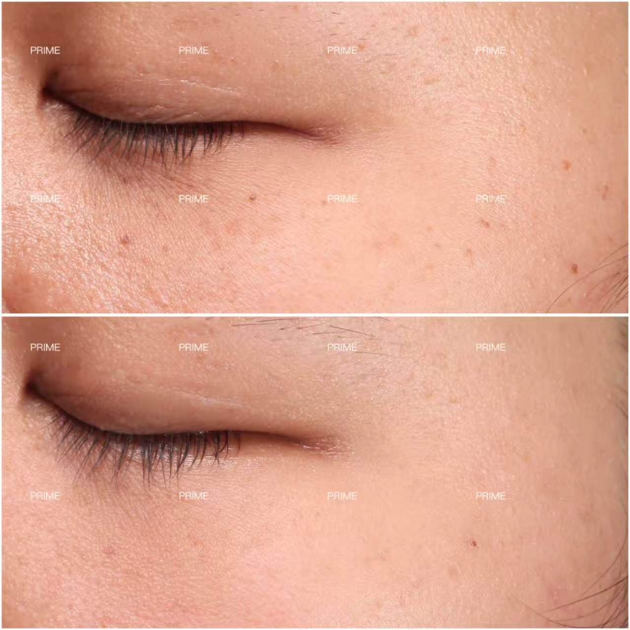 Skin lesion removal before and after result 02 from Prime Cosmetic Clinic