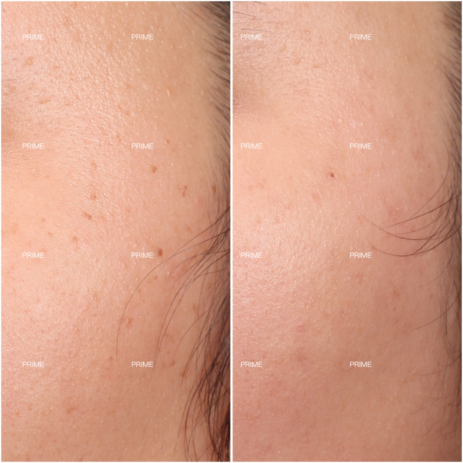 Skin lesion removal before and after result 03 from Prime Cosmetic Clinic