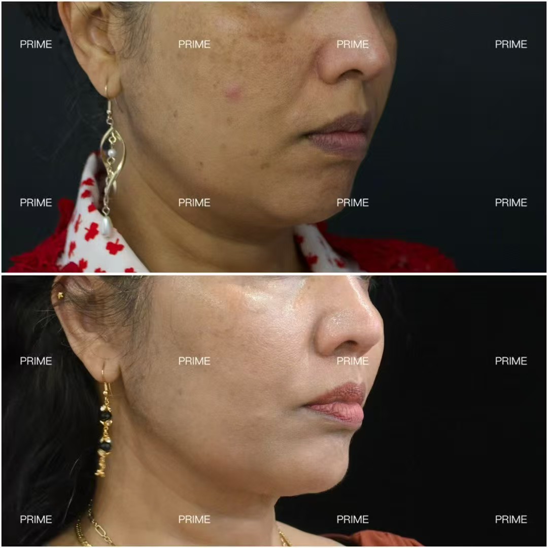 Prime Cosmetic Clinic before and after side profile result