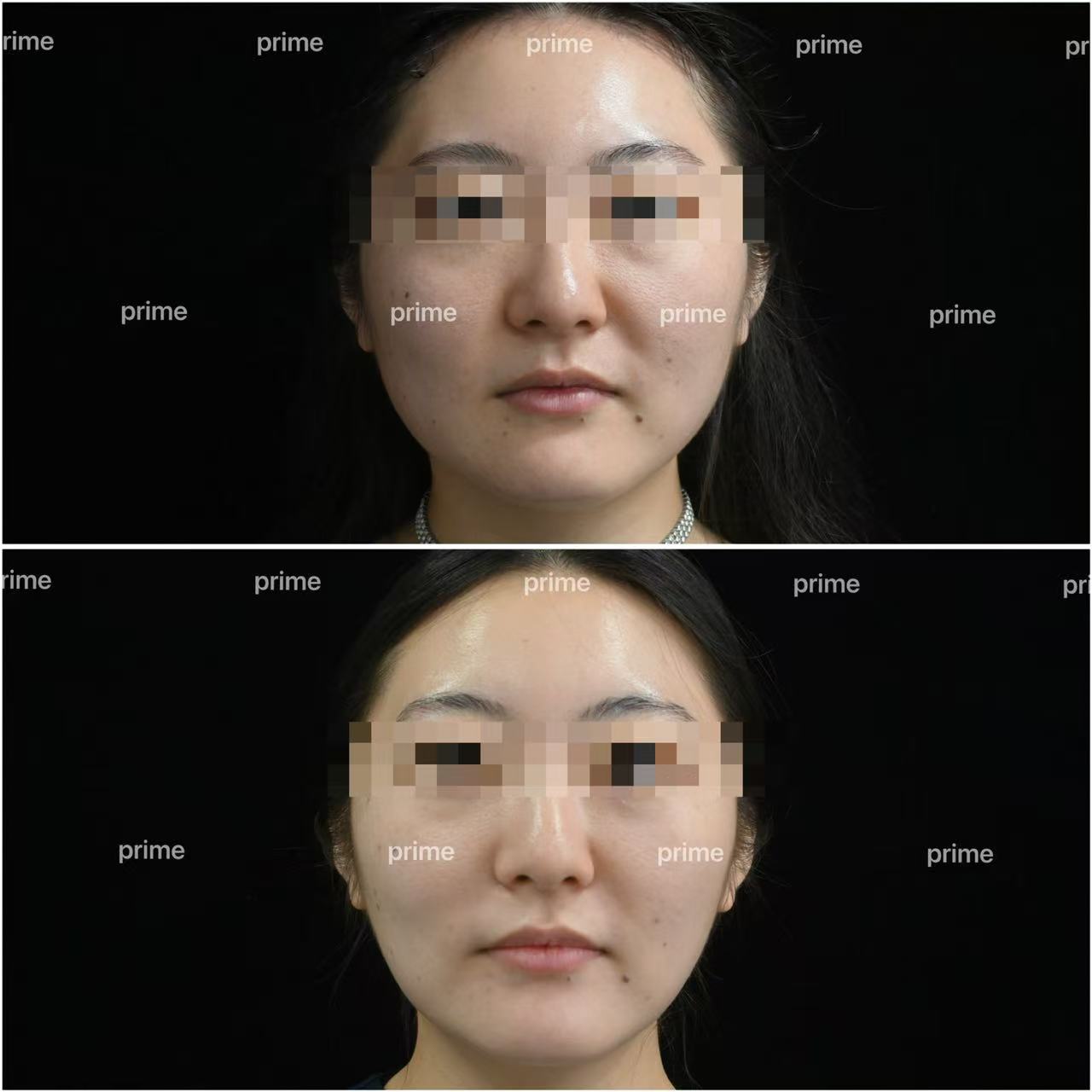 Prime Cosmetic Clinic before and after front face result