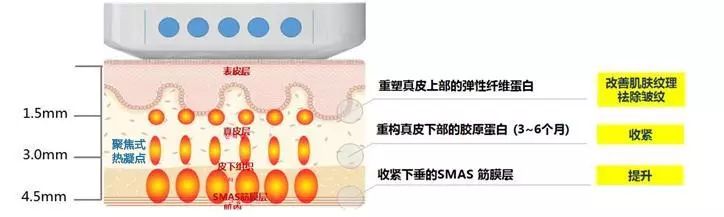 超声刀就是烤肉也没关系，因为它对脸垮是真的有效！|超声刀|胶原蛋白|皮肤_新浪女性_新浪网